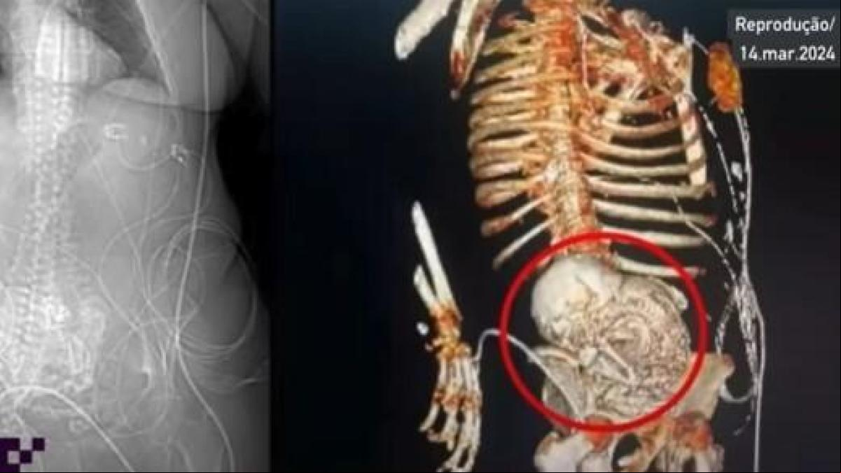 Muere una mujer al retirarle un bebé de piedra que portaba en su interior desde hace 30 años