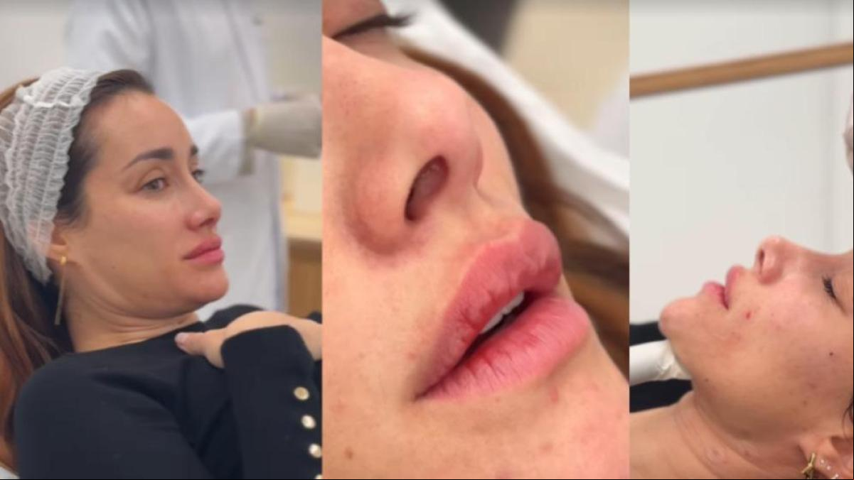 Adara Molinero sorprende a sus seguidores al desvelar sus nuevos retoques estéticos: Para mejorar la apariencia