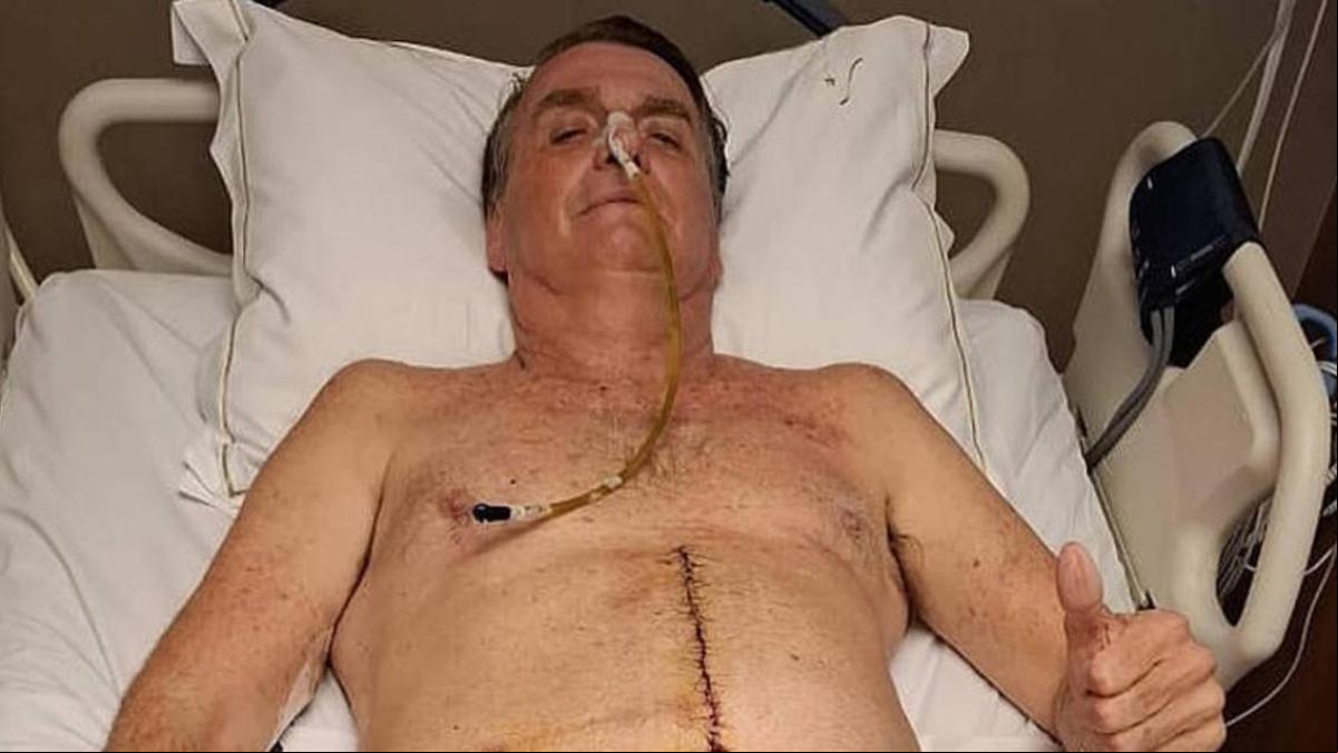 Bolsonaro circula en redes una foto de sus intestinos durante una intervención quirúrgica