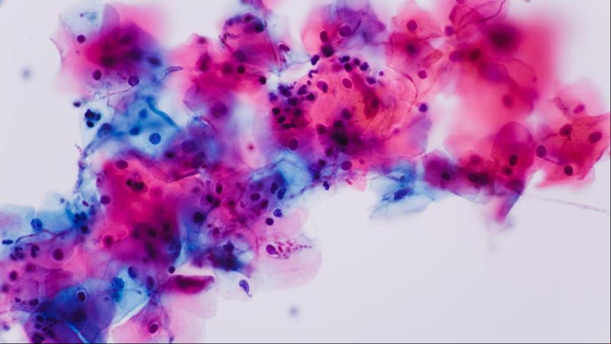 Candidiasis, síntomas y causas que debes conocer