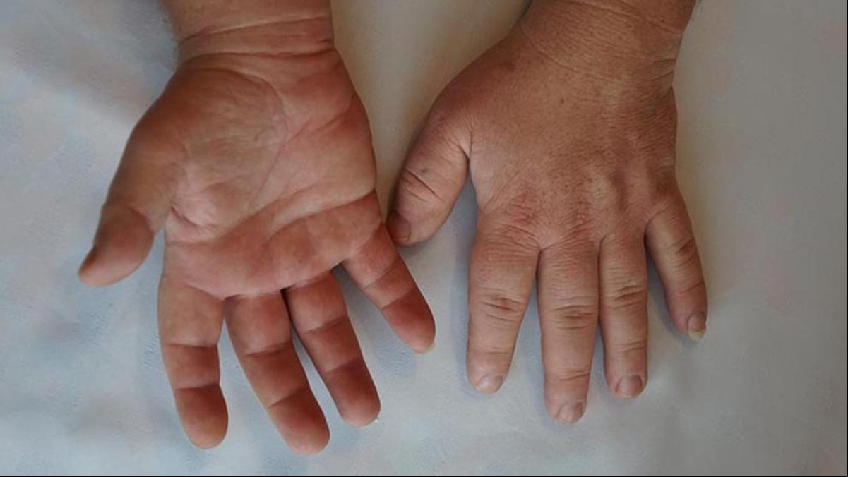 Acromegalia y sus síntomas y causas reveladoras