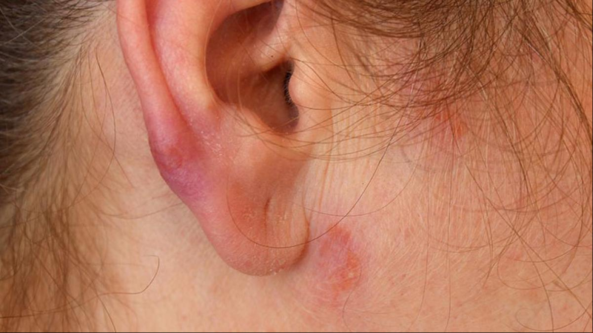 Sarcoidosis: descubre las causas y cómo tratar esta enfermedad