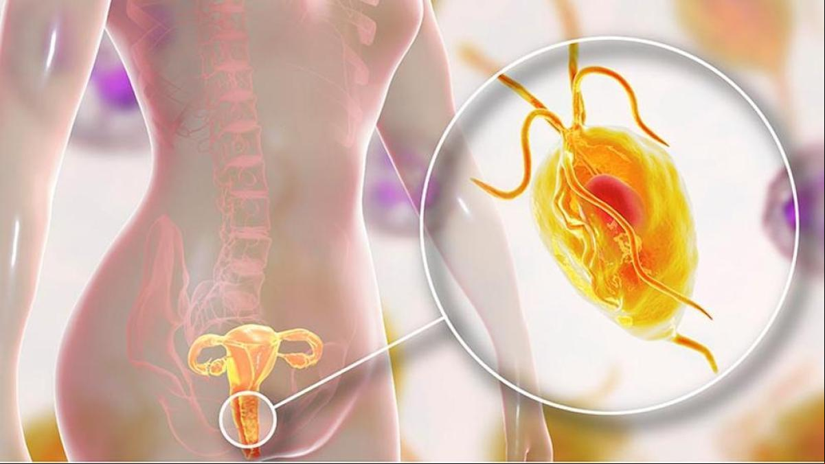 Trichomonas vaginalis: qué es y cómo tratar esta infección de transmisión sexual