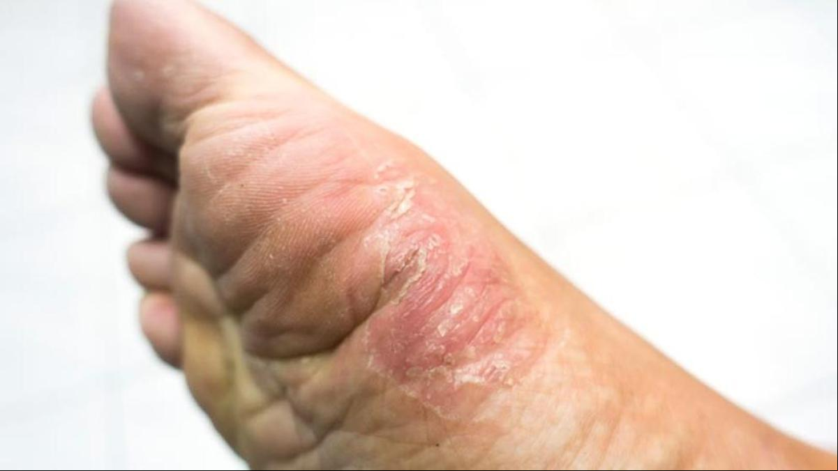 Pie de atleta: qué es y cómo tratar esta infección fúngica en los pies