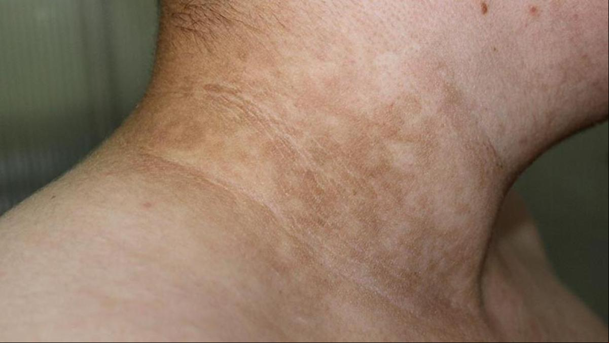 Acantosis nigricans, síntomas, causas y tratamientos que hacen la diferencia