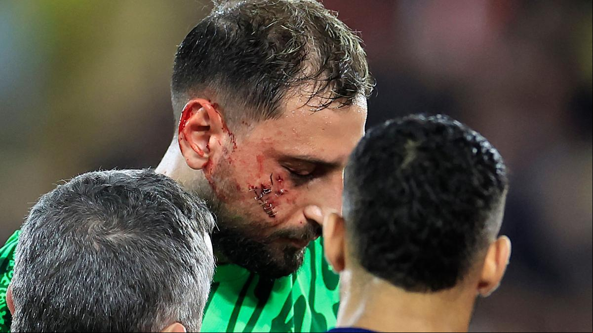 Donnarumma sufre un traumatismo facial tras recibir una escalofriante patada en la cara