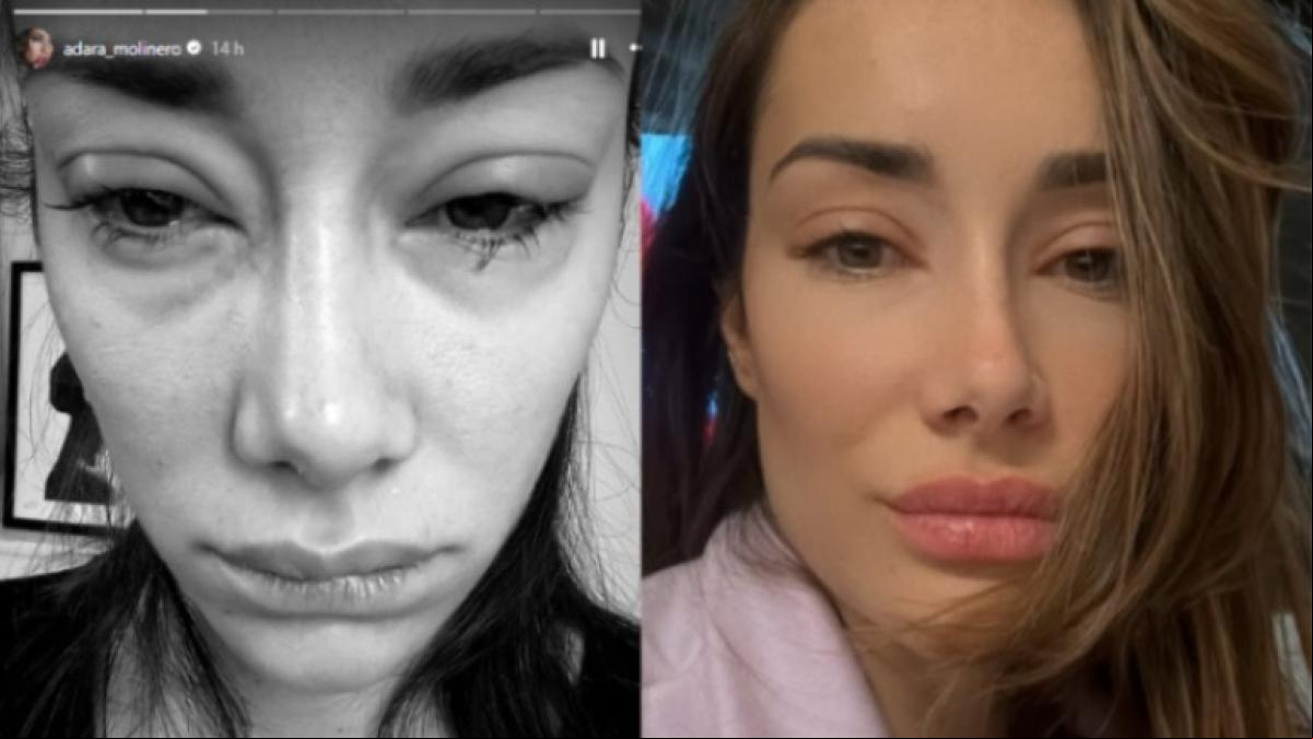 La impactante e inquietante fotografía de Adara Molinero con los ojos hinchados debido a una infección: He ido a urgencias
