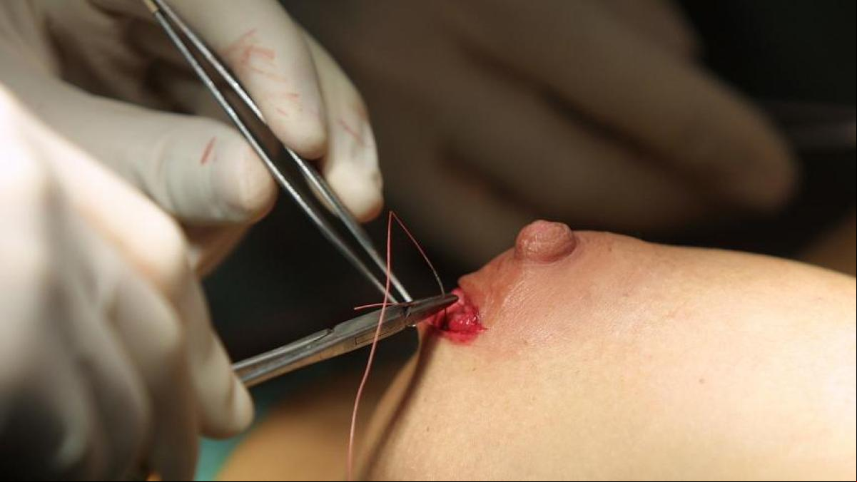 ¿Por qué las mujeres tienden a retirarse los implantes de pecho?