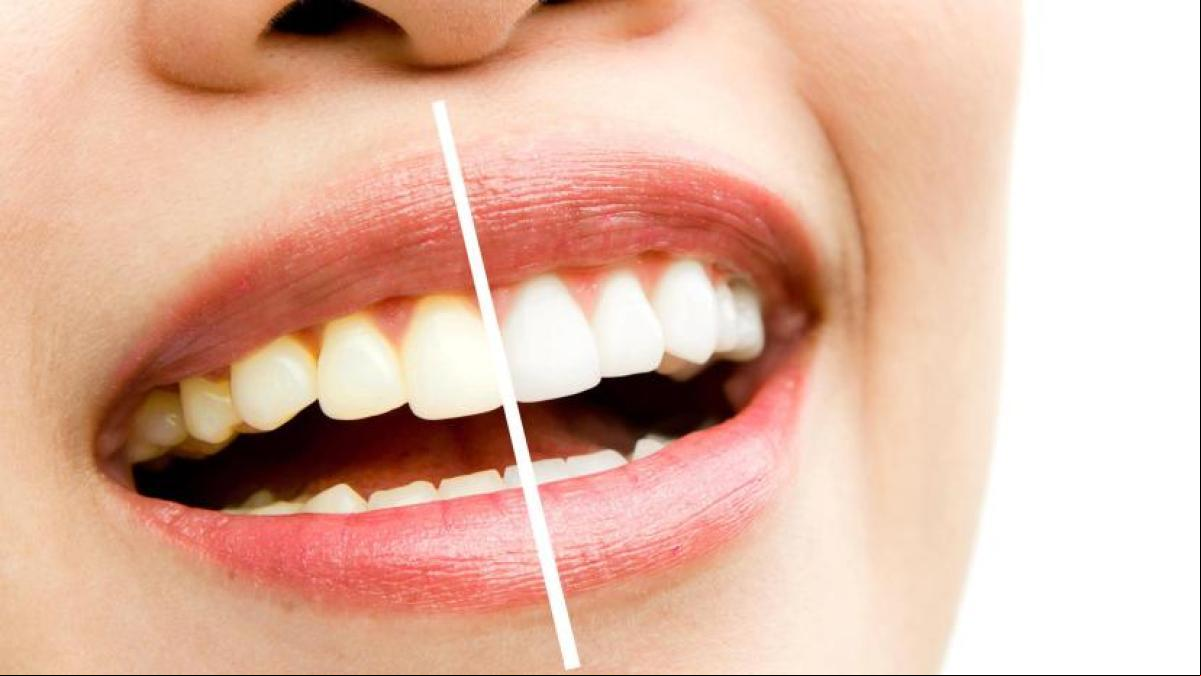 Joan-Pau Marcó, ortodoncista: “El aceite de coco no blanquea los dientes, es publicidad engañosa”