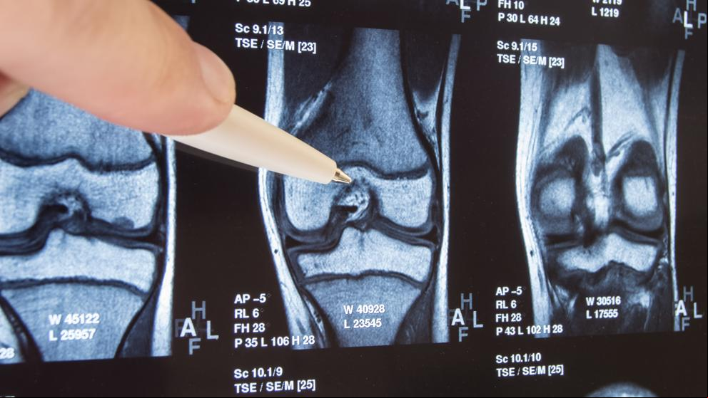 Científicos del MIT idean una terapia para regenerar los cartílagos con artrosis