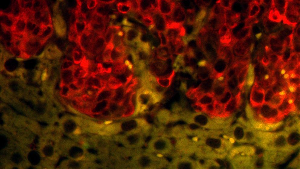¿Puede la bioimpresión 3D mejorar la supervivencia del cáncer?